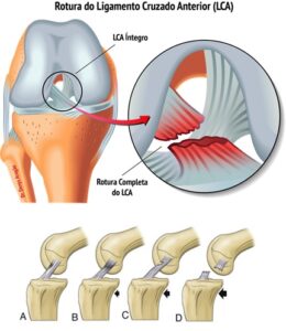 O que é o Ligamento Cruzado Anterior LCA Dr Denys Aragão