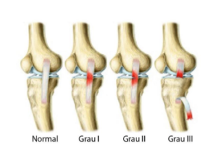 O Que Ligamento Colateral Medial Do Joelho Lcm Dr Denys Arag O