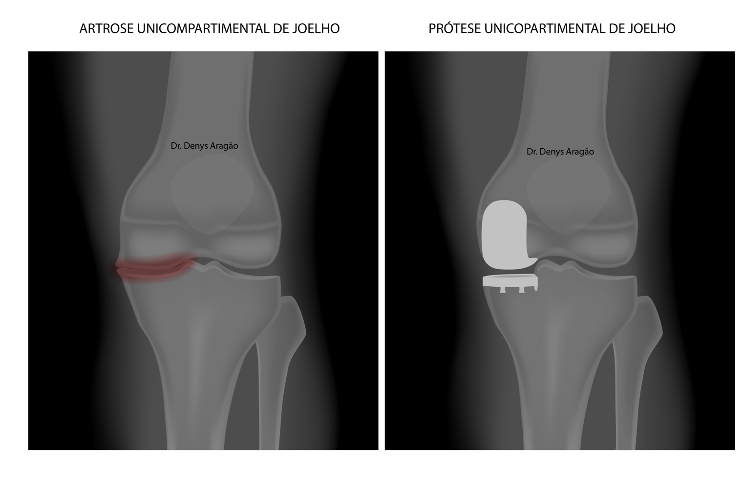 Artrose Unicompartimental de Joelho | Dr. Denys de Aragão