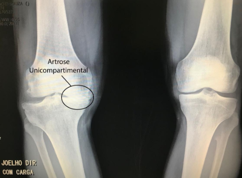 Artrose Unicompartimental | Dr. Denys Aragão