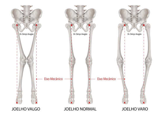 Joelho Valgo e Joelho Varo | Dr. Denys Aragão