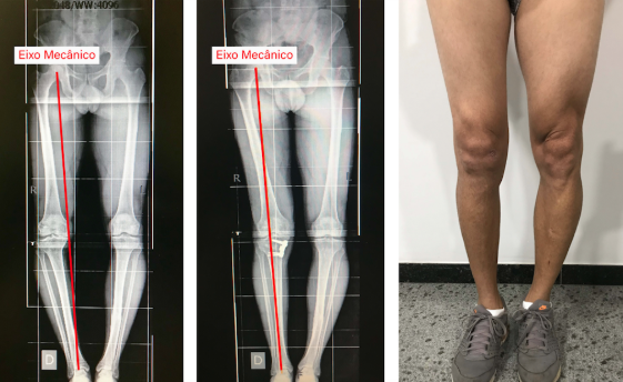 Osteotomia de joelho | Dr. Denys Aragão