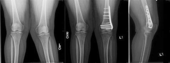 Osteotomia femoral distal | Dr. Denys Aragão