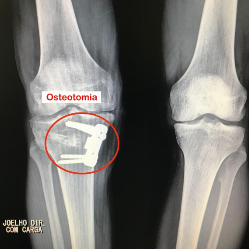 Osteotomia | Dr. Denys Aragão