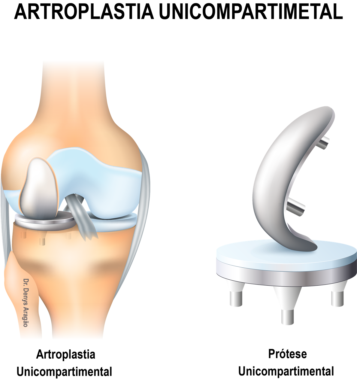 Prótese Unicompartimental | Dr. Denys Aragão